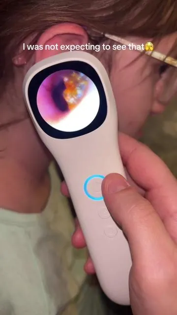 So gross but also so cool👏🏼 #otoscope #earcamera #earwax #picleen #tiktokshopspringglowup 
