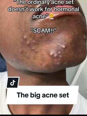 My skin has truly been changed with this acne set if your struggling like I was try out this acne set bundle @The Ordinary #theordinary #skincare #hormonalacne #darkspot #menskincare 