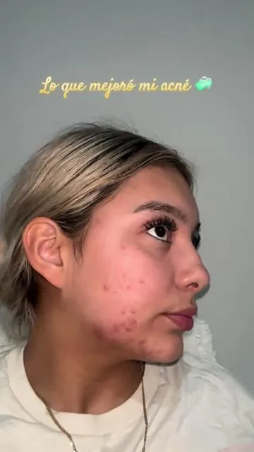 Todos me preguntaron que ayudó mi acné y esto es💛 TK: #acne #skincare #drleodryinglotionplus #salicylicacid #springtok 