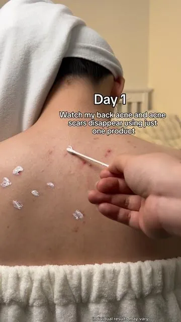 You don’t have to’just deal with’back acne,this cleared mine in 2 weeks.💁🏻‍♀️#backacne #skincare #drleohonestreview #limitedtimeoffer #acnetreatment 