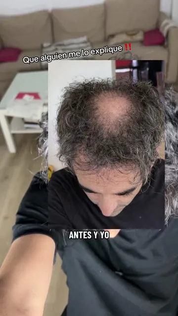 Mi experiencia personal  despúes de 7 meses usando minoxidil 😍#resultsmayvary #minoxidil #caidadecabello  el video es solo mi experiencia y no consejo médico. Si tienes dudas de salud consulta a un médico