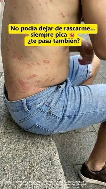 Ese pequeño punto rojo no es tan inofensivo 😳  te ha pasado 18 #psoriasis #pruebareal #sannuocream #pielsensible #rese #herbalcream #eczema #greenish #tiktokshopspringglowup #itchyskin