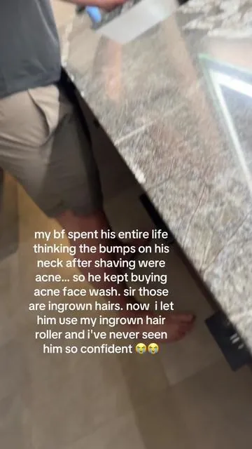so happy for him 🥹  #ingrownhair #shavingbumps #ingrownhairs #bfrelatable #couplegoals      