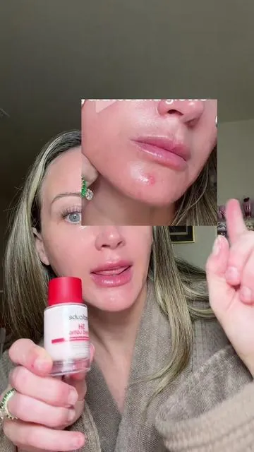 #acnetreatment #hormonalbreakouts 