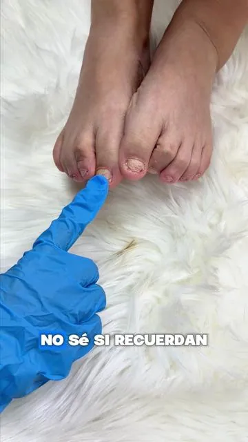 ¡Transforma tus uñas con nuestra solución para hongos en las uñas con tolnaftato 10x! Proporciona reparación y nutrición profunda, fortalece las uñas y previene su rotura.#cuidadodeuñas #uñasdelospies #uñas #tiktokmademebuyit #fyp