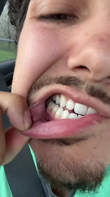 Wait till the end for the insane results #teethwhitening #teeth 