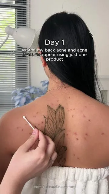 Summer is coming, and I won't allow acne on my back! I want to wear a beautiful bikini to the beach🏝️#tiktokshopstockup #skincareroutine #drleodryinglotion #acne #glowuptips 