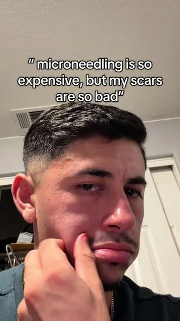 #acnescars #microneedling #viral 