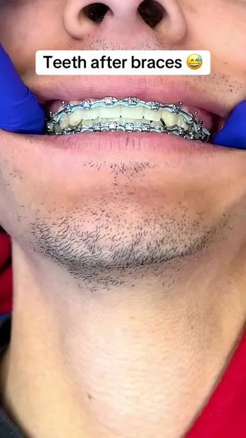 How do they look!? 😅 #gaptaincrunch #fyp #viral #TikTokShopCreatorPicks #teethwhitening 