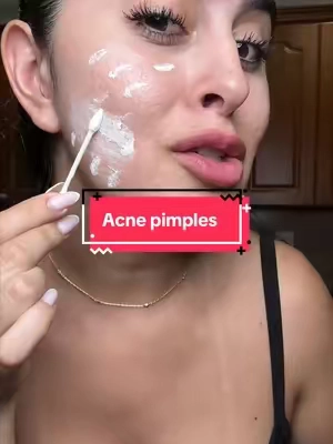 Acne and pimples #drleodryinglotionplus #salicylicacid #acne #skincare #tiktokshopcreatorpicks 