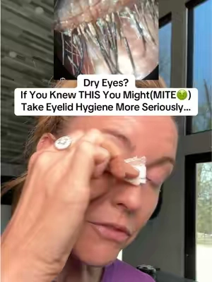 Everyone needs eyelid hygiene BUT especially if you have dry irritated eyes. Tea tree oil + hyaluronic acid is such great combo. Never use undiluted tree oil on, in, or near your eyes. Always discuss your eye concerns with your eye doctor. Not medical advice. #eyehealth #dryeye #holistichealth #dryeyerelief #naturalmedicine 
