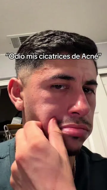 Nunca volveré a usar otra cosa‼️ #pielsana #cicatricesdeacne #acne #viral 