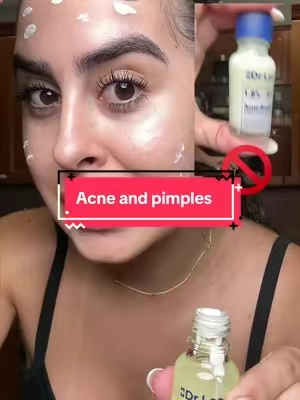 Acne #drleodryinglotionplus #salicylicacid #acne #skincare #tiktokshopcreatorpicks 