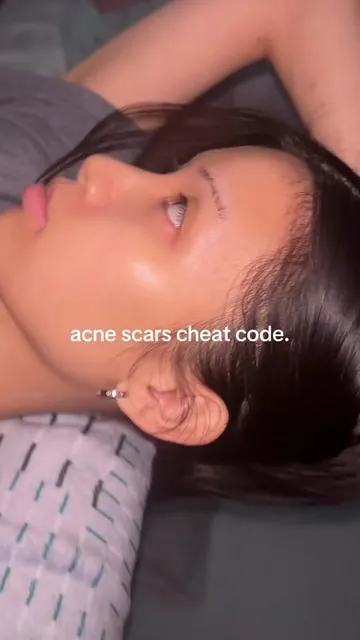 this cream actually WORKSSS I'm on my 7th tube😫🫶🏻 #dralthea #dralthea345cream #clearskin #acne #koreanskincare