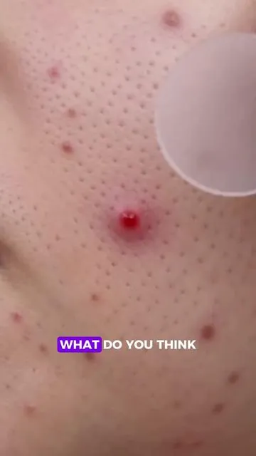 A quick way to remove blackheads and keep your nose fresh and clear. #NosePatch #ClearPores #BlackheadRemoval #tiktokshopstockup #mothersdaygift