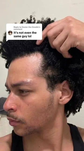 Replying to @Dexter the Doodle bro, do you need prescription glasses 😂 #fyp #viral #hairgrowth #balding #recedinghairline 
