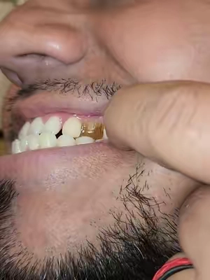 moldable teeth  ##moldablefalseteeth  #missingteeth #teeth 