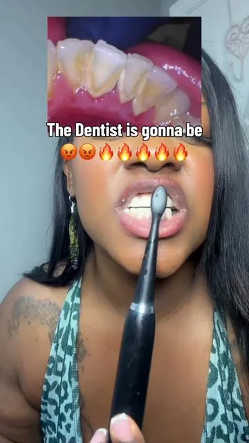 My Teeth looks and feels so much better! #plaqueremoval #plaqueremover #tartarremover #dentalcare #oralcare 