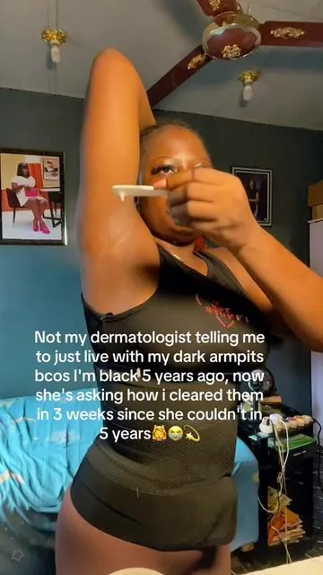 I could barley see those dark traces anymore !! 💃💯💫 #darkarmpits #darkunderarms #discoloration #unevenskintone #brighteningmask 
