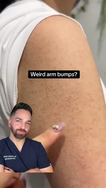 Weird arm bumps? #remedy #kp #keratosis #strawberryskin 