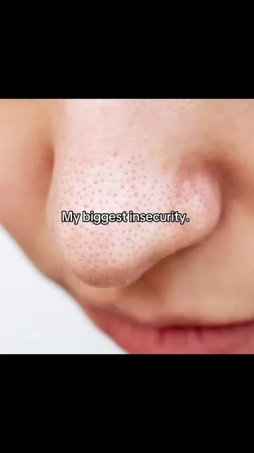 This helped me so much!! #blackhead #blackheadextractor 