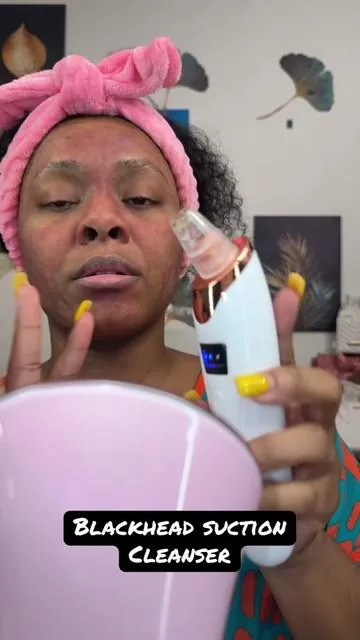 My Facials just went to another level 🔥😍  #blackhead #removal #vacuum #skincare #acneproneskin 