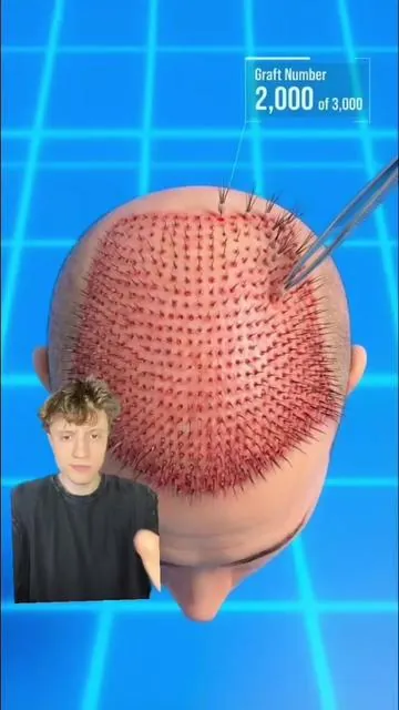 I think I’m ok off a hair transplant #hairtransplant #dht #dhtblocker #hairloss 