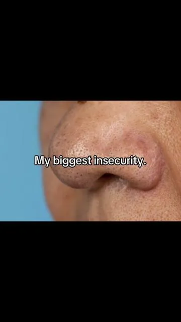 #blackheads#skincare 