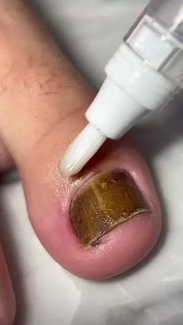 My toenails are finally showing a natural healthy change.#tiktokshop #tiktokshop #tiktok