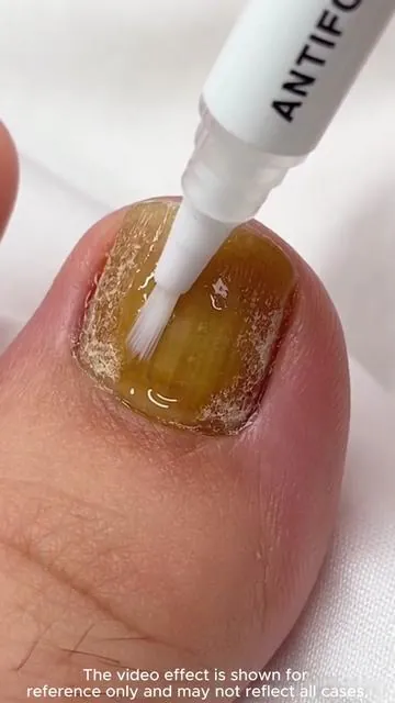 Pay Attention To Your Toenail Problem Before It Gets Serious #toenails #nail #tiktokshop #fyp