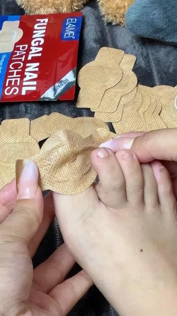 Funky nails? Not anymore. These patches are SAVING toes 🦶💥 #NailTok #FootCare #FungalNails #NailFix #BeforeAndAfter         