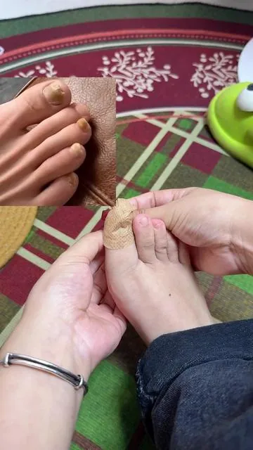 Funky nails? Not anymore. These patches are SAVING toes 🦶💥 #NailTok #FootCare #FungalNails #NailFix #BeforeAndAfter         
