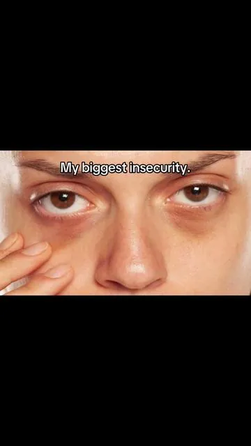 I used to hate my eyebags… finally found something that worked.. #eyebags 