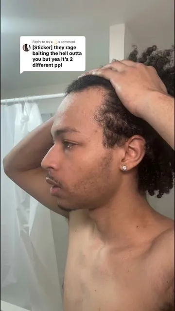 Replying to @𝕿𝖞★💫 I know it’s hard to believe, but the impossible is possible. ##fyp##viral##balding##hairlinerestoration