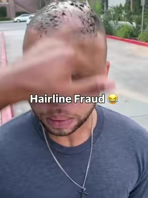 Hairline fraud 😂😂😂 #dht #dhtblocker #hairloss 