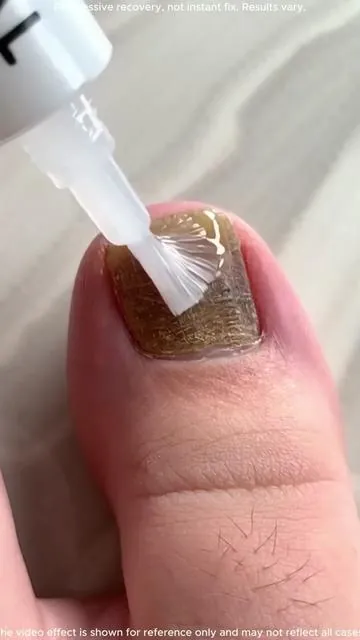 Anyone with troublesome toenails should definitely try this! #nailcare #toenailrepair #nailroutine #nailtok #fyp