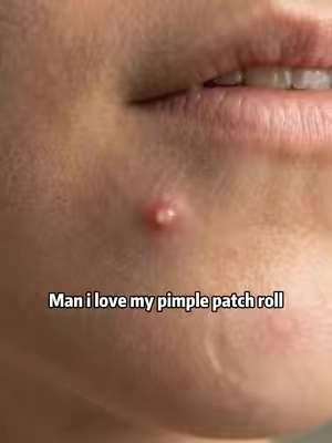 #fyp #pimple #pimplepatch #Summervibes #tiktokshopdealsforyoudays 