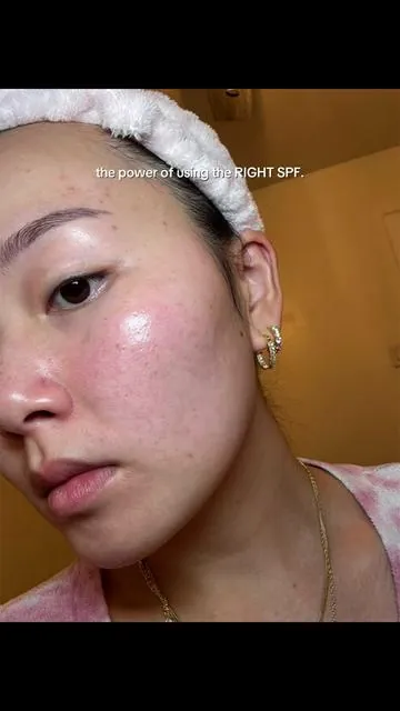 will FOREVER rave about this, its TRANSFORMED my skin 😭 @SKIN1004 US  #sunprotection #acnescars #hyperpigmentation #acneproneskin #koreansunscreen 