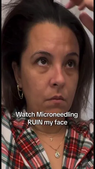 POV: microneedling "ruined" my face so bad that now I don't even wanna wear foundation anymore. And people keep asking the name of my clinic 🫠 @Seranova Beauty  #microneedling #microneedlingtherapy