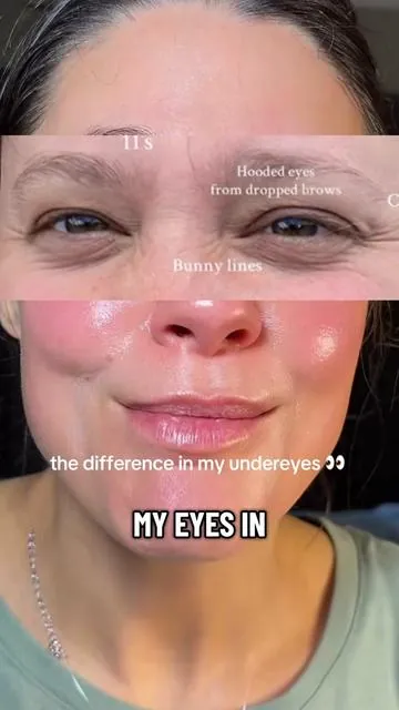 My under eyes have changed so much over the past decade and keeping them hydrated has made a bigger difference than expensive makeup ever did. These eye patches make my under eyes look smoother, less tired, and so much more refreshed. #eyepatches #undereyecare #matureskin #koreanskincare #tiktokshop @Biodance Store US 