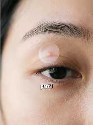 #fyp #pimple #pimplepatch #SummerWins #tiktokshopdealsforyoudays 