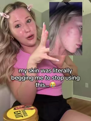okay but why did beef tallow calm my skin down more than all the expensive products I’ve tried.😭 #acnetok #beeftallow #acnejourney #beforeandafter #tiktokmademebuyit 
