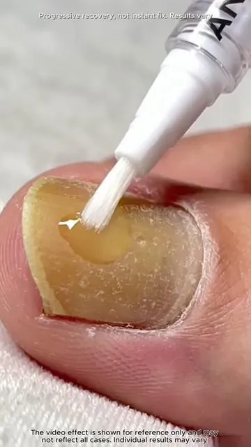 Got the same stubborn nail problem You have to try this!#SummerWins  #DealsForYouDays  #nailcare  #toenails #nailtok