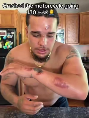 If I didn’t find this I thought I was done for …. 🤦‍♂️ #scars #scarremover #scarcream 