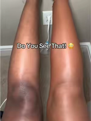 It works so well omg! #westmorebeauty #bodycoverage #dealsforyoudays #hyperpigmentation #bodymakeup @Westmore Beauty 