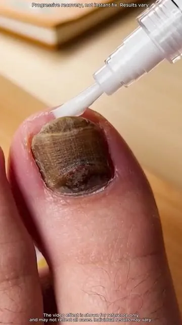 If you’re dealing with the same nail issue, you should definitely give this a try! #toenails #nailtok #fyp #DealsForYouDays