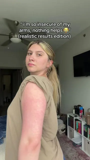 after years of trying everything and avoiding tank tops, finally sound something clearing my KP 🥲 #KP #strawberryskin #skintransformation #SummerWins #DealsForYouDays 