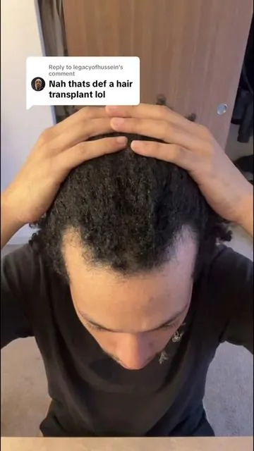 Replying to @legacyofhussein definitely not a hair transplant. #balding #hairloss #fyp #viral #menbalding 