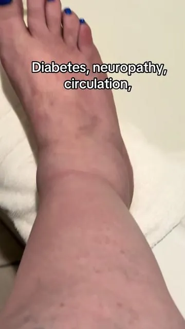 #Diabetes #Circulation.  #Socks. #DealsForFewDays. #Summervibes 