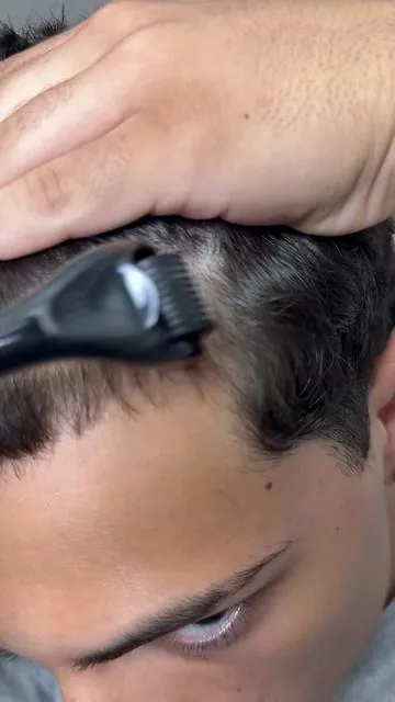 The truth about microneedling 🧐 #fyp #tiktokshop #microneedling #hair 
